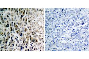 Immunohistochemical analysis of paraffin- embedded lung carcinoma. (CHEK2 anticorps  (pThr68))