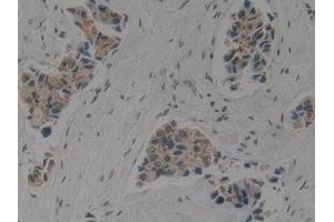 Detection of CK1 in Human Breast cancer Tissue using Polyclonal Antibody to Cytokeratin 1 (CK1) (Cytokeratin 1 anticorps  (AA 487-644))