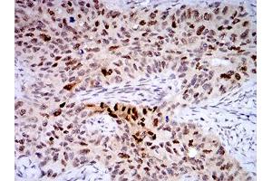 Immunohistochemical analysis of paraffin-embedded cervical cancer tissues using TTF1 mouse mAb with DAB staining. (TTF1 anticorps  (AA 1-150))