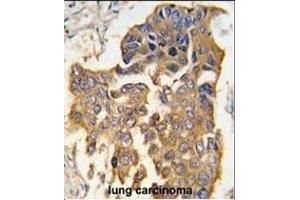 Formalin-fixed and paraffin-embedded human lung carcinoma tissue reacted with CASP9 antibody (Center) (ABIN392509 and ABIN2842072) , which was peroxidase-conjugated to the secondary antibody, followed by DAB staining. (Caspase 9 anticorps  (AA 183-211))