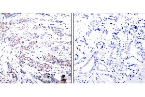 Immunohistochemical analysis of paraffin- embedded breast carcinoma. (ELK1 anticorps  (Ser383))