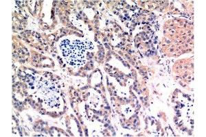 Immunohistochemical analysis of paraffin-embedded Human Breast Carcinoma Tissue using Bax Mouse mAb diluted at 1:200.