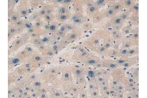 Detection of aZGP1 in Human Liver Cancer Tissue using Polyclonal Antibody to Alpha-2-Glycoprotein 1, Zinc Binding (aZGP1)