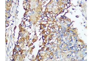 Immunohistochemistry of paraffin-embedded human esophageal using Carbonic Anhydrase 9 (C/G250) Rabbit mAb (ABIN1680827, ABIN3019284, ABIN3019285 and ABIN7101745) at dilution of 1:100 (40x lens). (CA9 anticorps)