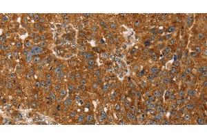 Immunohistochemistry of paraffin-embedded Human breast cancer tissue using TBC1D1 Polyclonal Antibody at dilution 1:45 (TBC1D1 anticorps)