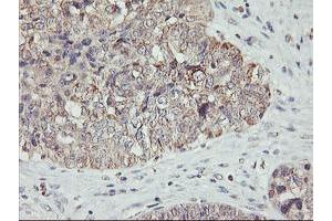 Immunohistochemical staining of paraffin-embedded Adenocarcinoma of Human ovary tissue using anti-AGPAT5 mouse monoclonal antibody. (AGPAT5 anticorps)
