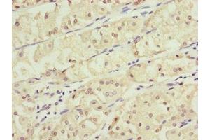 Immunohistochemistry of paraffin-embedded human gastric cancer using ABIN7157235 at dilution of 1:100 (KANSL3 anticorps  (AA 1-200))