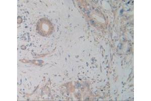 IHC-P analysis of Human Cholangiocarcinoma Tissue, with DAB staining. (alpha Actinin 4 anticorps  (AA 1-269))