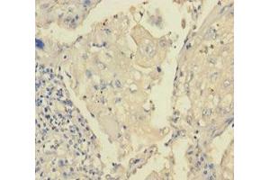 Immunohistochemistry of paraffin-embedded human lung cancer using ABIN7172870 at dilution of 1:100