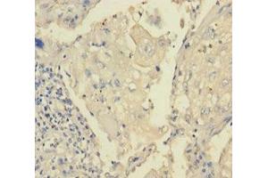 Immunohistochemistry of paraffin-embedded human lung cancer using ABIN7172870 at dilution of 1:100 (TRPM8 anticorps  (AA 1-192))