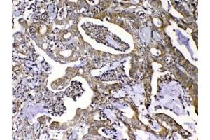 IHC testing of FFPE human colon cancer tissue with MMP16 antibody at 1ug/ml.