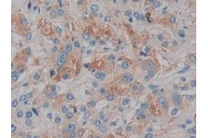 Detection of IL2 in Human Prostate cancer Tissue using Monoclonal Antibody to Interleukin 2 (IL2) (IL-2 anticorps  (AA 21-153))