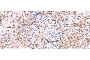 Immunohistochemistry of paraffin-embedded Human cervical cancer tissue using OSBPL2 Polyclonal Antibody at dilution of 1:55(x200) (OSBPL2 anticorps)