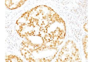 Formalin-fixed, paraffin-embedded human Prostate Carcinoma stained with ERCC1 Mouse Monoclonal Antibody (ERCC1/2318).