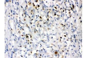 Anti- Lipocalin 2 Picoband antibody, IHC(P) IHC(P): Human Intestinal Cancer Tissue (Lipocalin 2 anticorps  (AA 21-198))