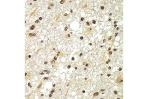 Immunohistochemistry of paraffin-embedded human brain cancer using ZNF20 antibody  at dilution of 1:100 (40x lens).