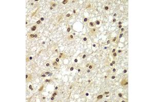 Immunohistochemistry of paraffin-embedded human brain cancer using ZNF20 antibody  at dilution of 1:100 (40x lens). (ZNF20 anticorps  (AA 1-200))