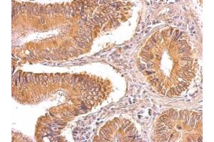 IHC-P Image TIP30 antibody detects TIP30 protein on human gastric cancer by immunohistochemical analysis. (HIV-1 Tat Interactive Protein 2, 30kDa (HTATIP2) anticorps)