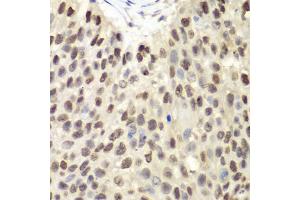 Immunohistochemistry of paraffin-embedded human lung cancer using MCM6 antibody (ABIN5971012) at dilution of 1/100 (40x lens). (MCM6 anticorps)