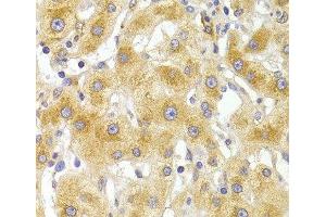 Immunohistochemistry of paraffin-embedded Human liver damage using EIF4G1 Polyclonal Antibody at dilution of 1:100 (40x lens).