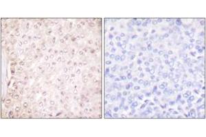 Immunohistochemistry analysis of paraffin-embedded human breast carcinoma tissue, using Stefin B Antibody.