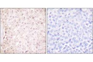 Immunohistochemistry analysis of paraffin-embedded human breast carcinoma tissue, using Stefin B Antibody. (CSTB anticorps  (AA 49-98))