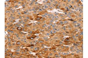 The image on the left is immunohistochemistry of paraffin-embedded Human liver cancer tissue using ABIN7192504(SLC5A11 Antibody) at dilution 1/25, on the right is treated with synthetic peptide. (Solute Carrier Family 5 (Sodium/inositol Cotransporter), Member 11 (SLC5A11) anticorps)