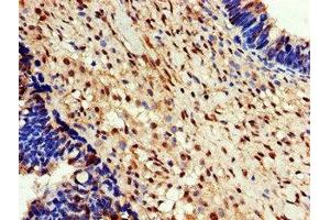 Immunohistochemistry of paraffin-embedded human ovarian cancer using ABIN7152101 at dilution of 1:100 (EEF2K anticorps  (AA 201-500))