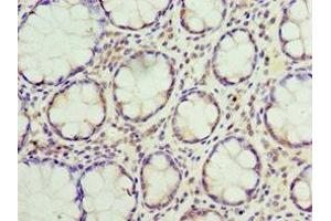 Immunohistochemistry of paraffin-embedded human colon cancer using ABIN7169893 at dilution of 1:100 (SUMO4 anticorps  (AA 1-95))