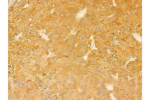 ABIN6262436 and ABIN6279508 at 1/100 staining human hepatocellular carcinoma by IHC-P. (ICAM5 anticorps  (C-Term))