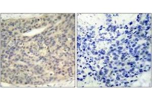 Immunohistochemistry analysis of paraffin-embedded human breast carcinoma, using LIMK1 (Phospho-Thr508) Antibody. (LIM Domain Kinase 1 anticorps  (pThr508))