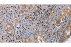 Immunohistochemistry of paraffin-embedded Human cervical cancer using GMFG Polyclonal Antibody at dilution of 1:50 (GMFG anticorps)