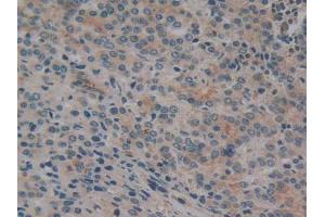 IHC-P analysis of Human Prostate Gland Cancer Tissue, with DAB staining. (CYLD anticorps  (AA 170-338))