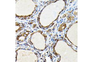 Immunohistochemistry of paraffin-embedded human thyroid cancer using FA Rabbit pAb (ABIN7267102) at dilution of 1:100 (40x lens). (FAM117A anticorps)