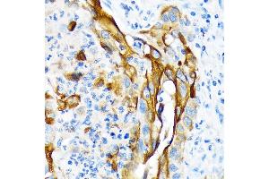 Immunohistochemistry of paraffin-embedded human lung squamous carcinoma tissue using Cytokeratin 13 (KRT13) (KRT13) Rabbit mAb (ABIN7268089) at dilution of 1:100 (40x lens). (Cytokeratin 13 anticorps)