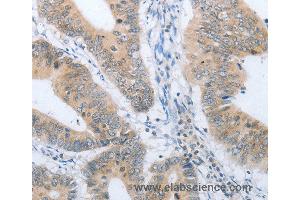 Immunohistochemistry of Human lung cancer using CHRNA10 Polyclonal Antibody at dilution of 1:50 (CHRNA10 anticorps)