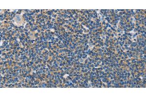 Immunohistochemistry of paraffin-embedded Human lymphoma tissue using NEK5 Polyclonal Antibody at dilution 1:60