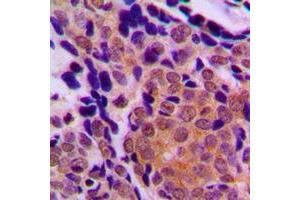 Immunohistochemical analysis of p63 staining in human breast cancer formalin fixed paraffin embedded tissue section. (TCP1 alpha/CCTA anticorps  (C-Term))