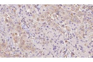 ABIN6273334 at 1/100 staining Human thyroid cancer tissue by IHC-P. (TRIM14 anticorps  (C-Term))