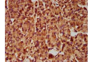 IHC image of ABIN7170028 diluted at 1:500 and staining in paraffin-embedded human pancreatic cancer performed on a Leica BondTM system.