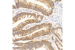 Immunohistochemistry of paraffin-embedded human colon carcinoma using eIF1A Rabbit mAb (ABIN7267027) at dilution of 1:50 (40x lens). (Eukaryotic Translation Initiation Factor 1A (EIF1A) anticorps)