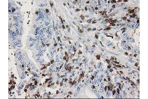 Immunohistochemical staining of paraffin-embedded Adenocarcinoma of Human colon tissue using anti-DEF8 mouse monoclonal antibody. (DEF8 anticorps)