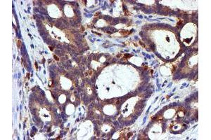 Immunohistochemical staining of paraffin-embedded Adenocarcinoma of Human colon tissue using anti-LIMK1 mouse monoclonal antibody. (LIM Domain Kinase 1 anticorps)