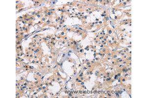 Immunohistochemistry of Human thyroid cancer using SENP1 Polyclonal Antibody at dilution of 1:25 (SENP1 anticorps)