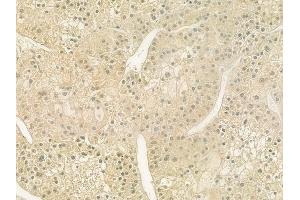 ABIN6259798 and ABIN6277719 at 1/100 staining human hepatocellular carcinoma by IHC-P. (ADH6 anticorps  (C-Term))
