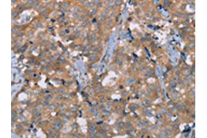 The image on the left is immunohistochemistry of paraffin-embedded Human breast cancer tissue using ABIN7191717(NRG3 Antibody) at dilution 1/30, on the right is treated with synthetic peptide.