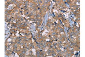 The image on the left is immunohistochemistry of paraffin-embedded Human breast cancer tissue using ABIN7191717(NRG3 Antibody) at dilution 1/30, on the right is treated with synthetic peptide. (Neuregulin 3 anticorps)