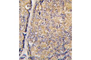Formalin-fixed and paraffin-embedded human prostate carcinoma tissue reacted with STAP1 antibody (N-term)(F56) , which was peroxidase-conjugated to the secondary antibody, followed by DAB staining.