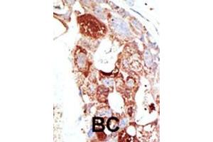 Formalin-fixed and paraffin-embedded human cancer tissue reacted with the primary antibody, which was peroxidase-conjugated to the secondary antibody, followed by DAB staining.
