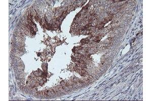 Immunohistochemical staining of paraffin-embedded Adenocarcinoma of Human endometrium tissue using anti-RLBP1 mouse monoclonal antibody. (RLBP1 anticorps)